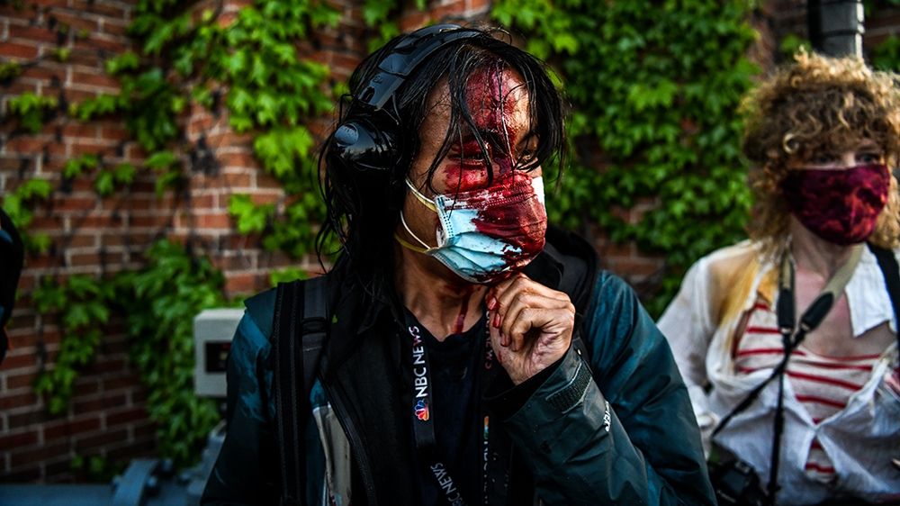 A journalist is seen bleeding after police started firing tear gas and rubber bullets in US protests