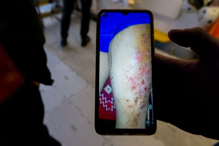 Some of the refugees held in Libya got scabies from the conditions they were in