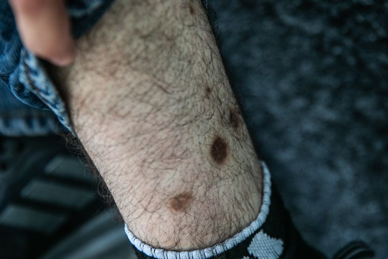 shrapnel scars