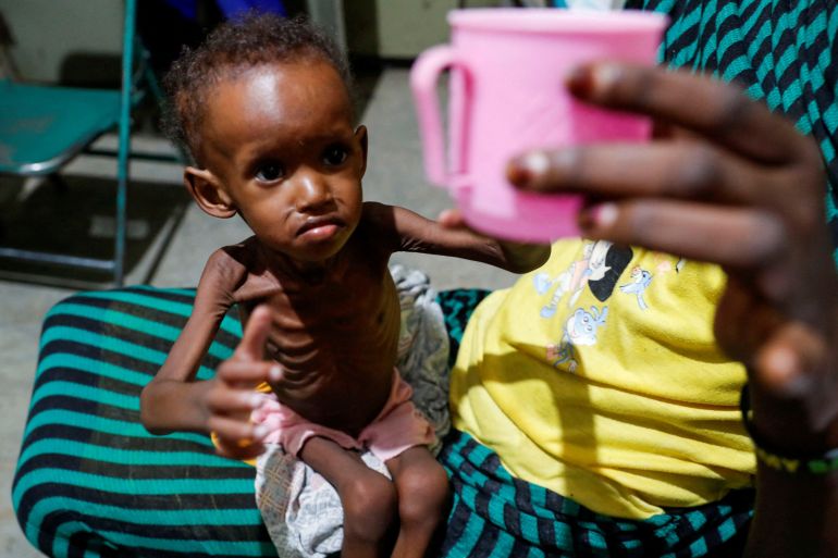 Saddam Najwa, a malnourished, 17-month-old internally displaced child