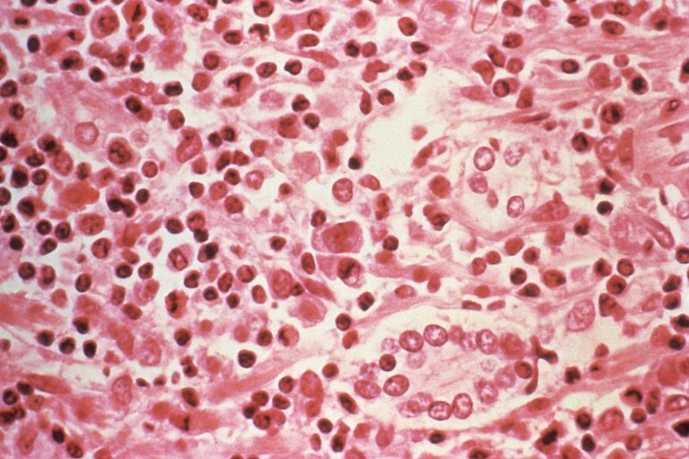 hantavirus